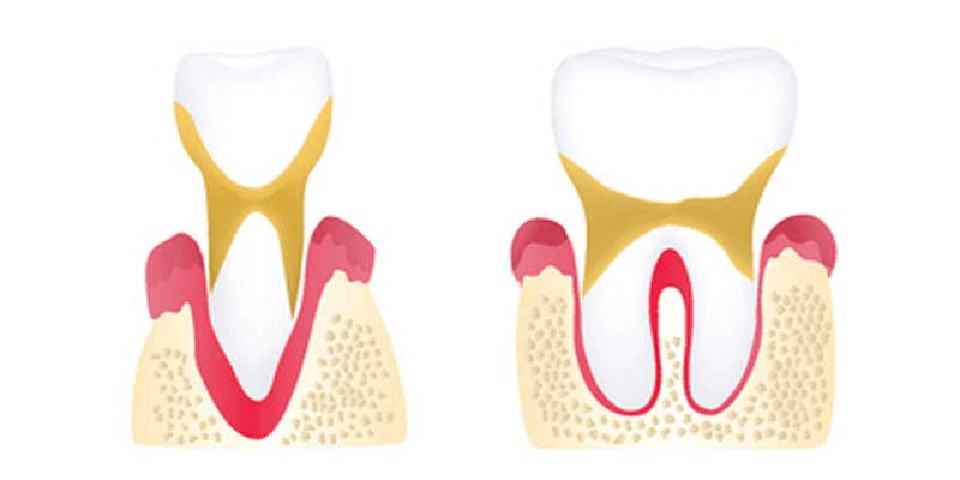 Advanced Periodontitis Photo