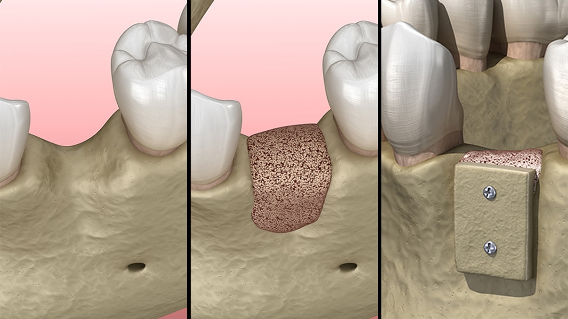 Socket Preservation Illustration
