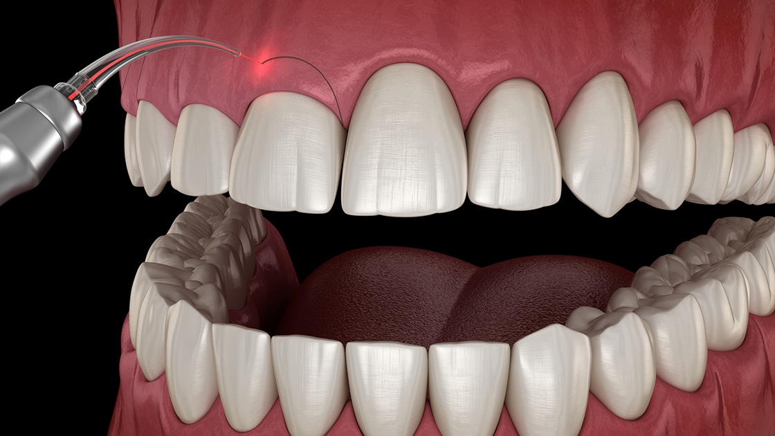Crown Lengthening Photo