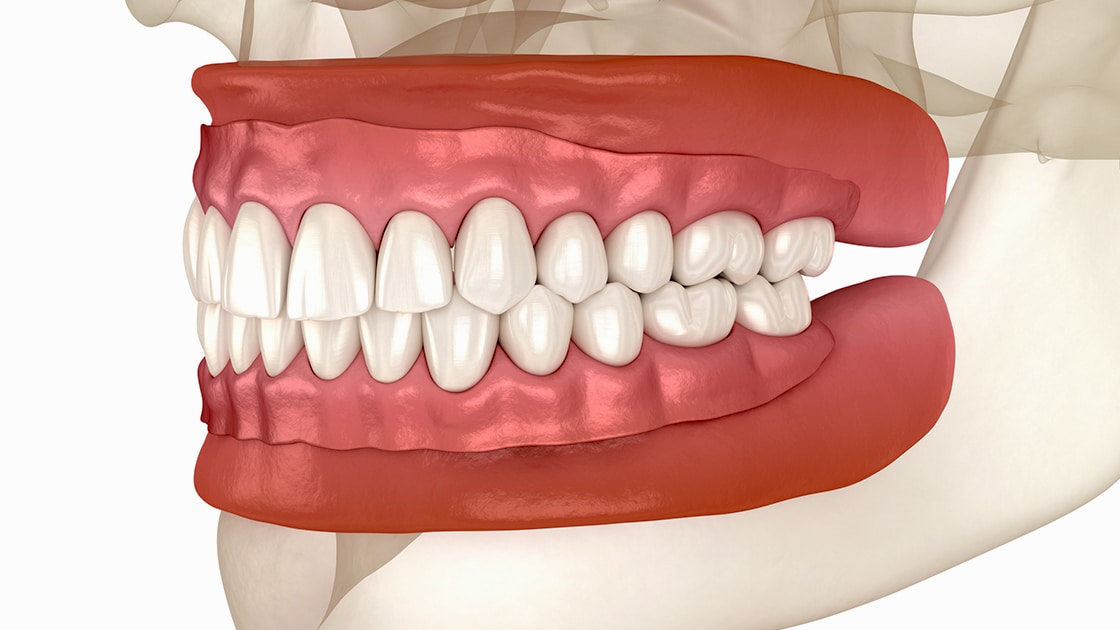 Denture Model