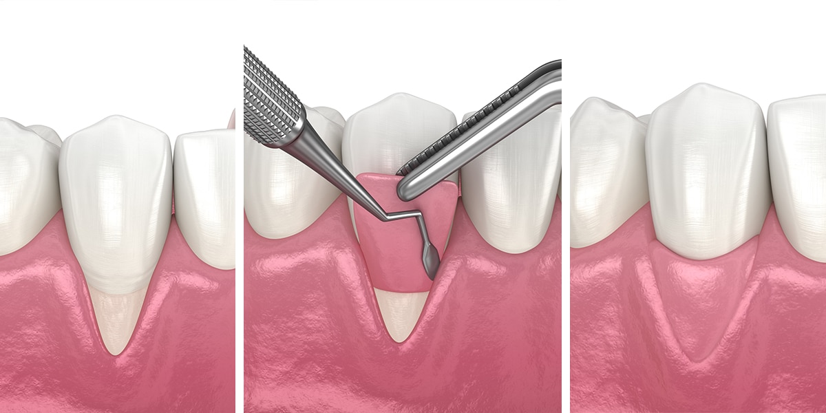 Gum Grafting Illustration
