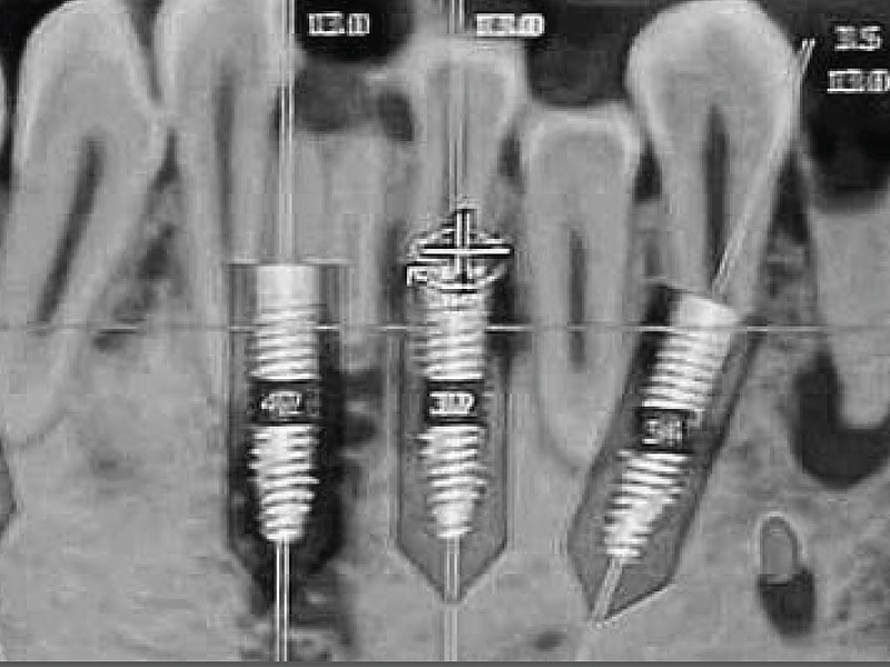 Dental Implants in X-ray