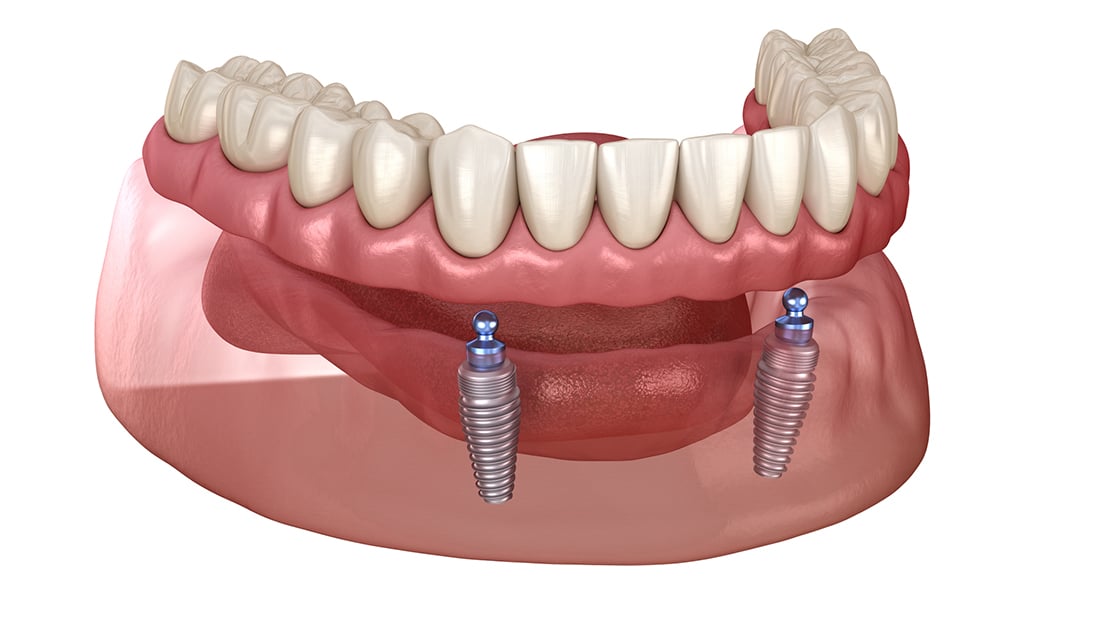 Implant Supported Dentures Illustration