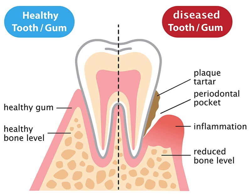 Diagram of Periodontal Disease