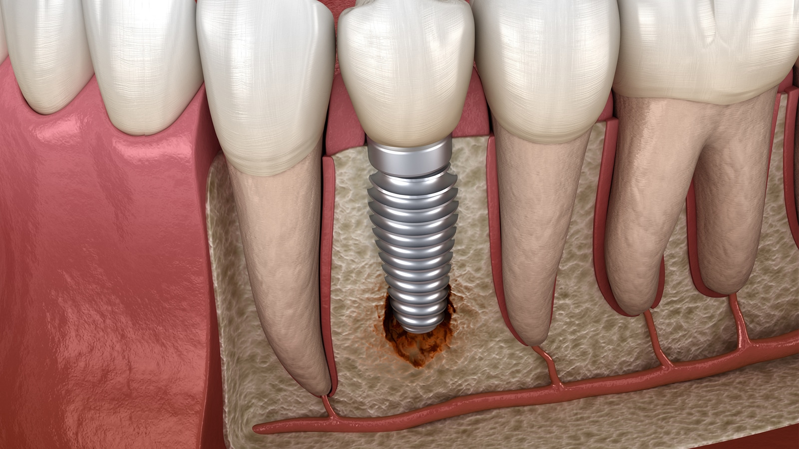 Peri-Implantitis Illustration
