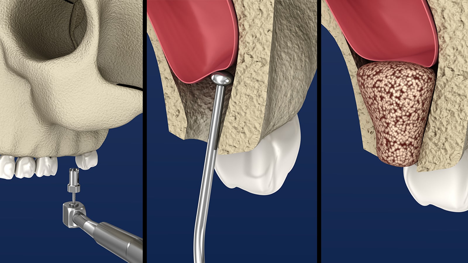 Sinus Lift Graft Illustration