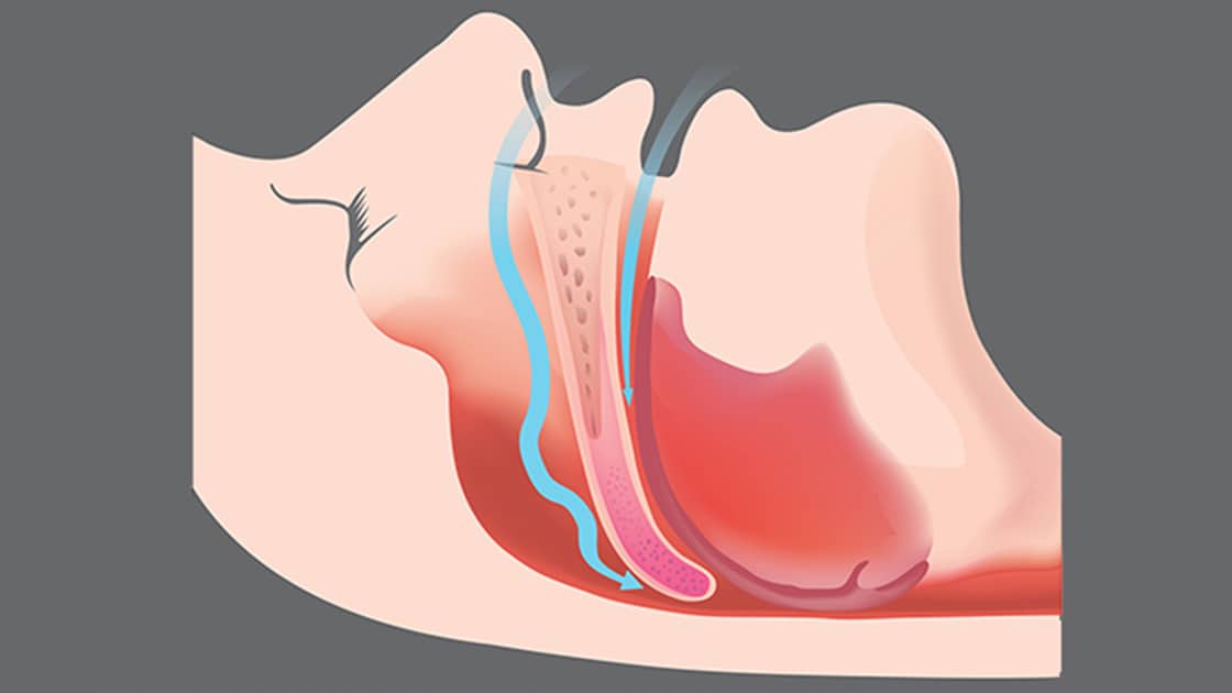 Sleep Apnea Diagram