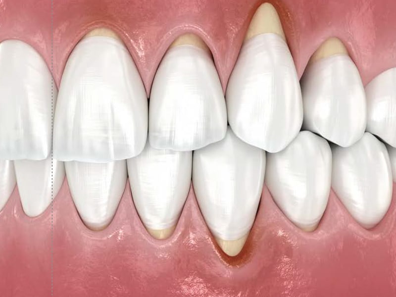 Soft Tissue recession